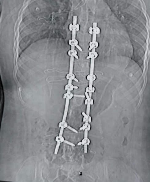 Successful Complex Surgery to Correct Severe Spinal Deformity at Benha University Hospitals  