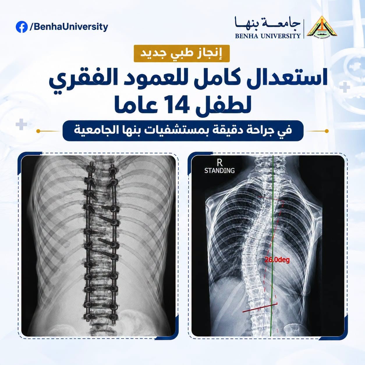 Complete Spinal Correction for a 14-Year-Old Child in a Precision Surgery at Benha University Hospitals